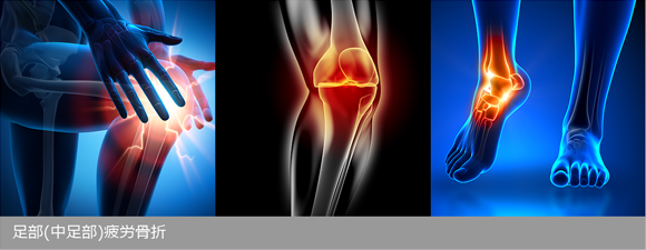 足部(中足部)疲労骨折