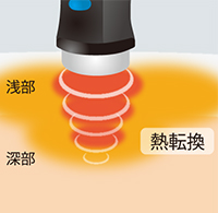 深部の患部も直接温める立体加温